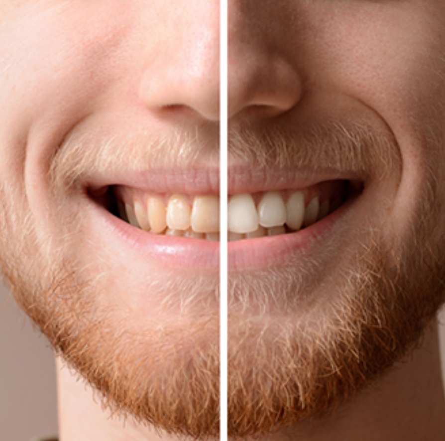 Nuvenci - Teeth Whitening Pen